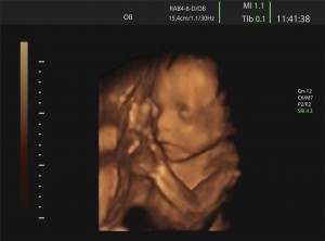 Ultrasom de bebê - Obstetrícia